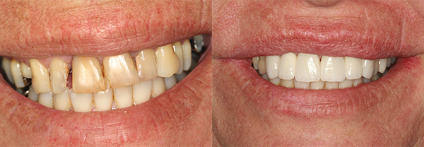 Before and after dental crowns