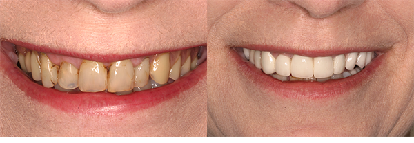 Before and after dental crowns