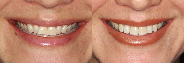 Before and after treatment with Invisalign®