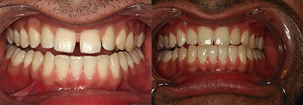 Before and after treatment with Invisalign®