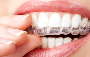 The Invisalign® system