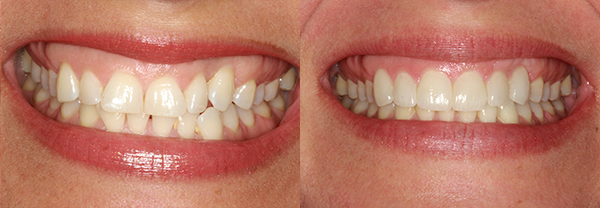 Before and after treatment with veneers