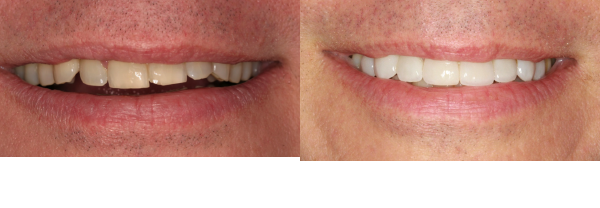 Before and after treatment with veneers
