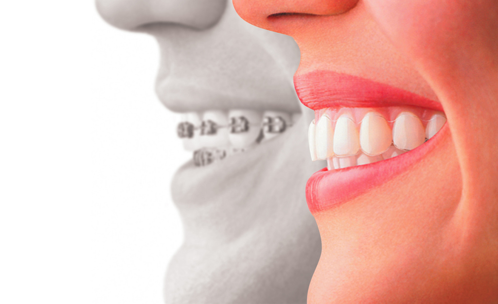 A picture of two different sets of teeth, one set is wearing metal braces, one is wearing Invisalign.